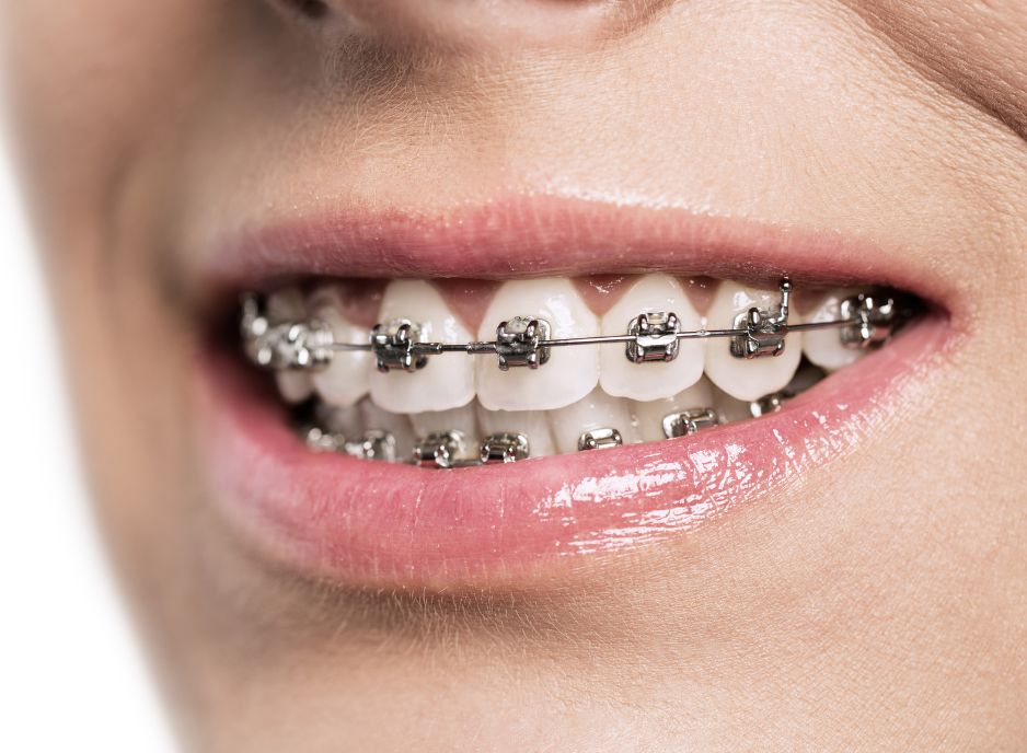 ortodoncia-brackets-metalicos-arenys-de-mar