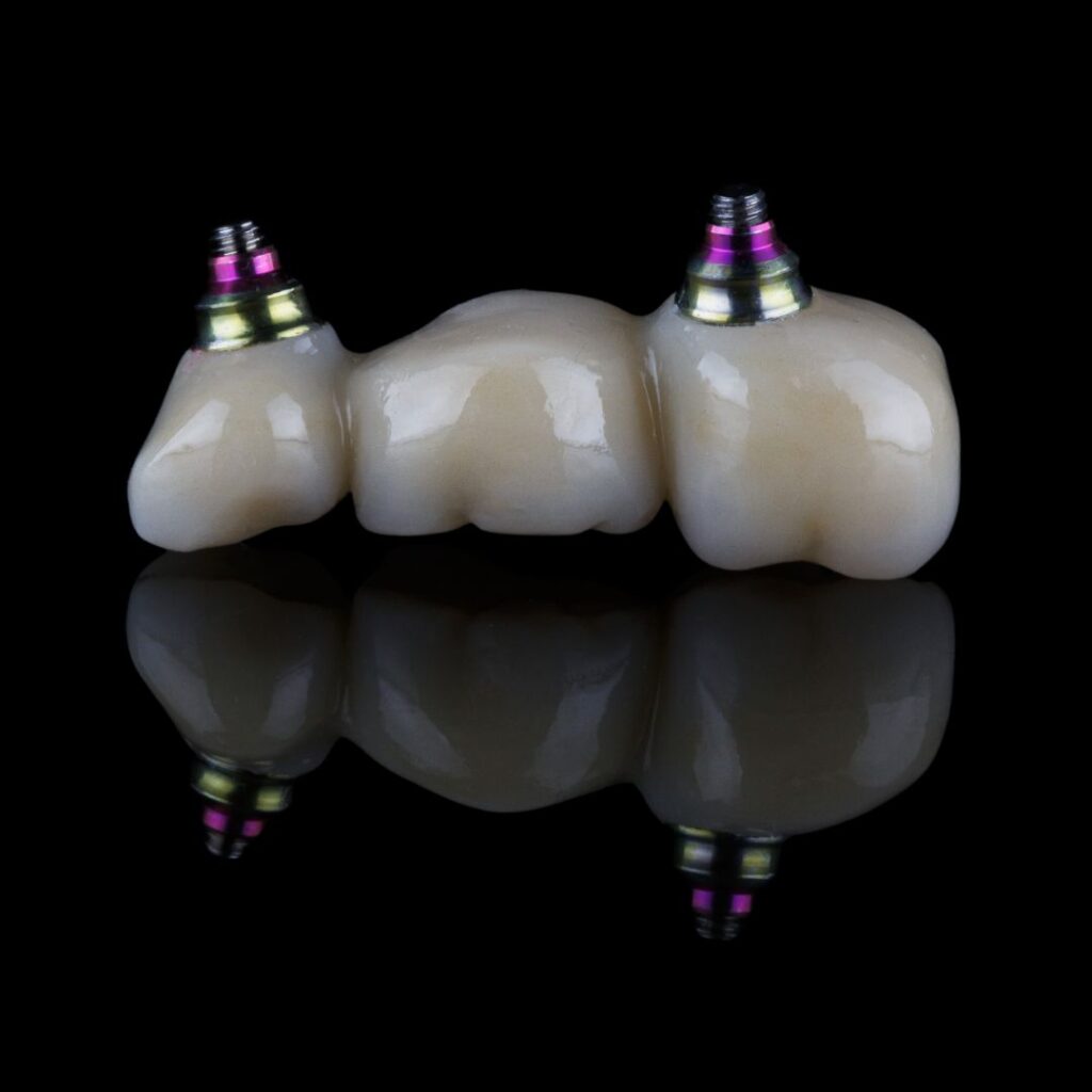 protesis-dental-fija-sobre-implantes